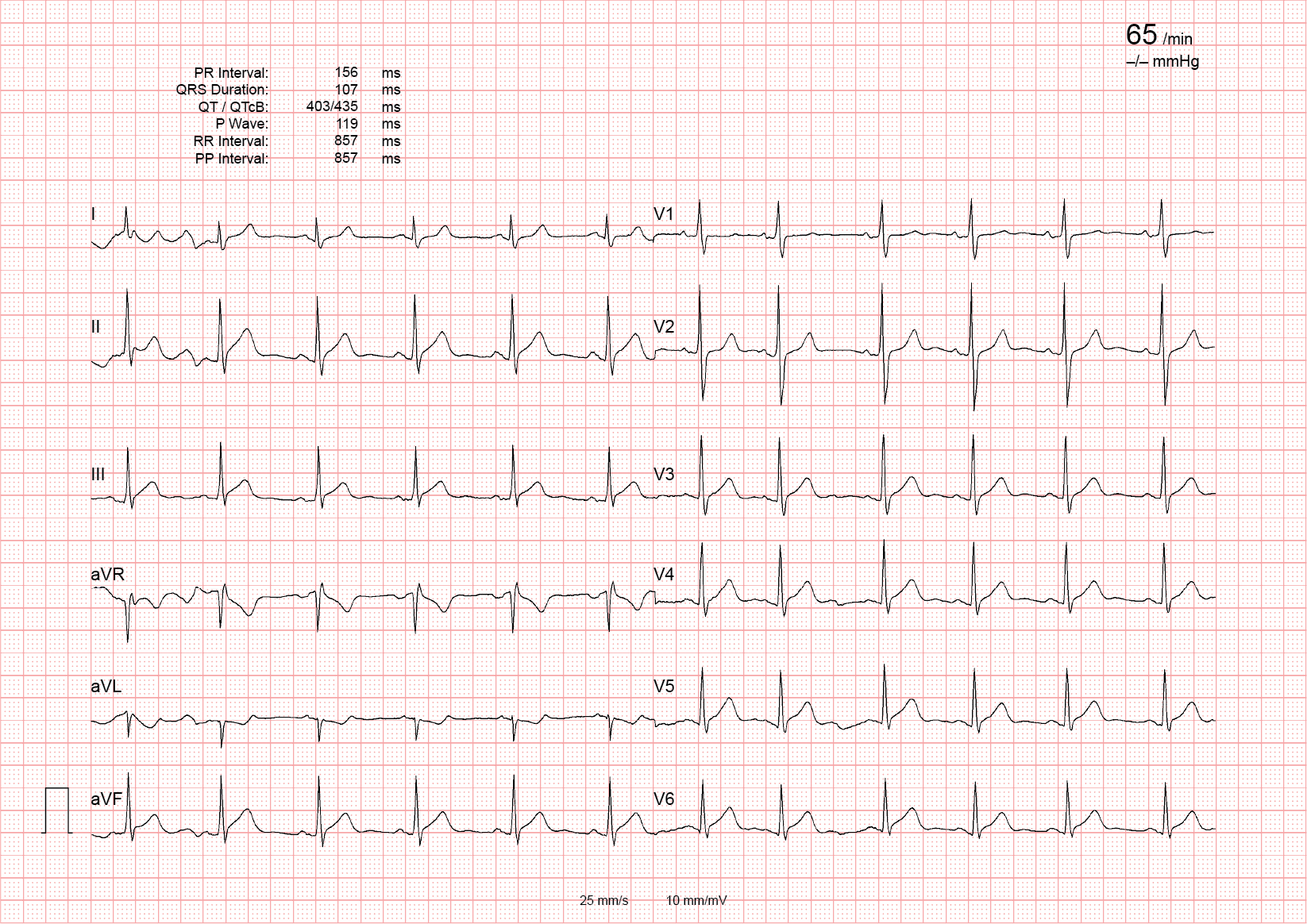 Sharp, clearly readable photo of a 12-lead ECG