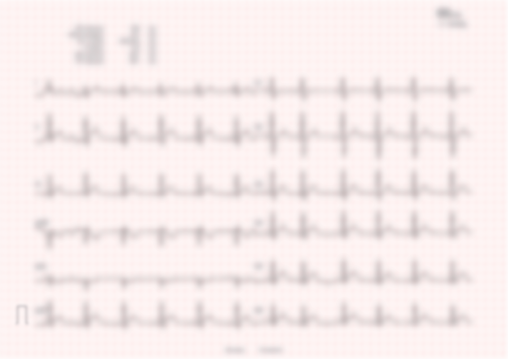 Blurred, low-quality photo of the same 12-lead ECG