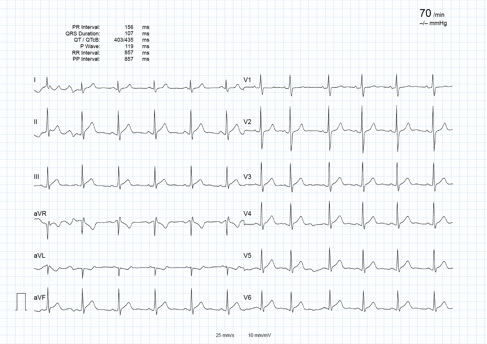 A complete 12-lead ECG