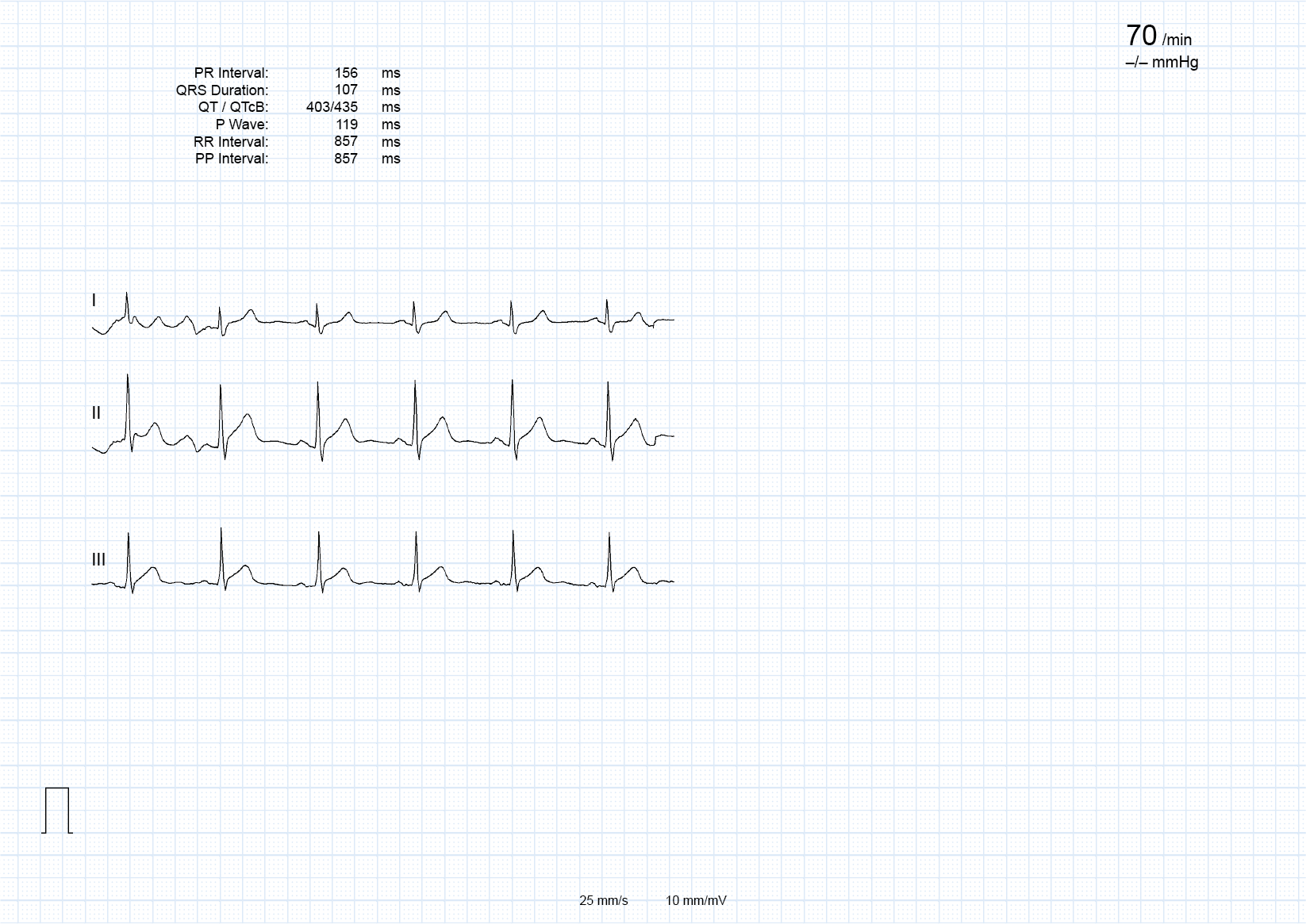 An ECG showing only three leads: I, II and III