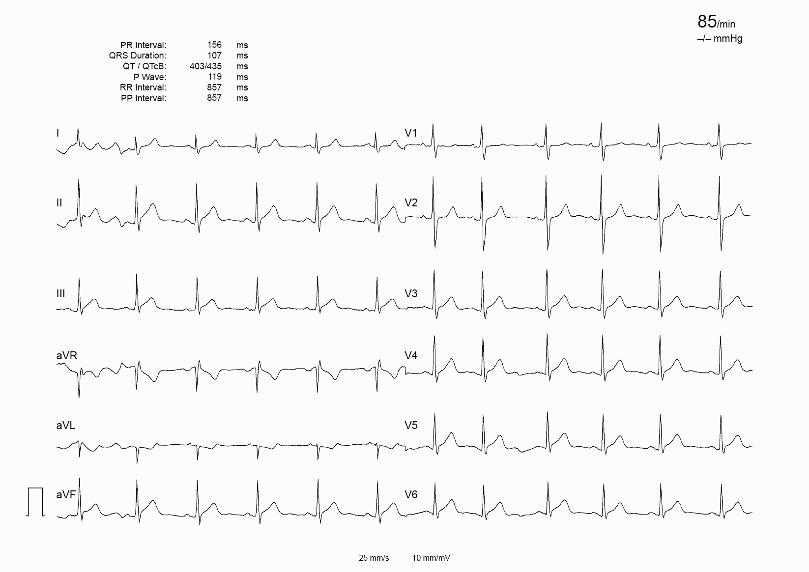 12-lead ECG printed on plain paper, with no grid
