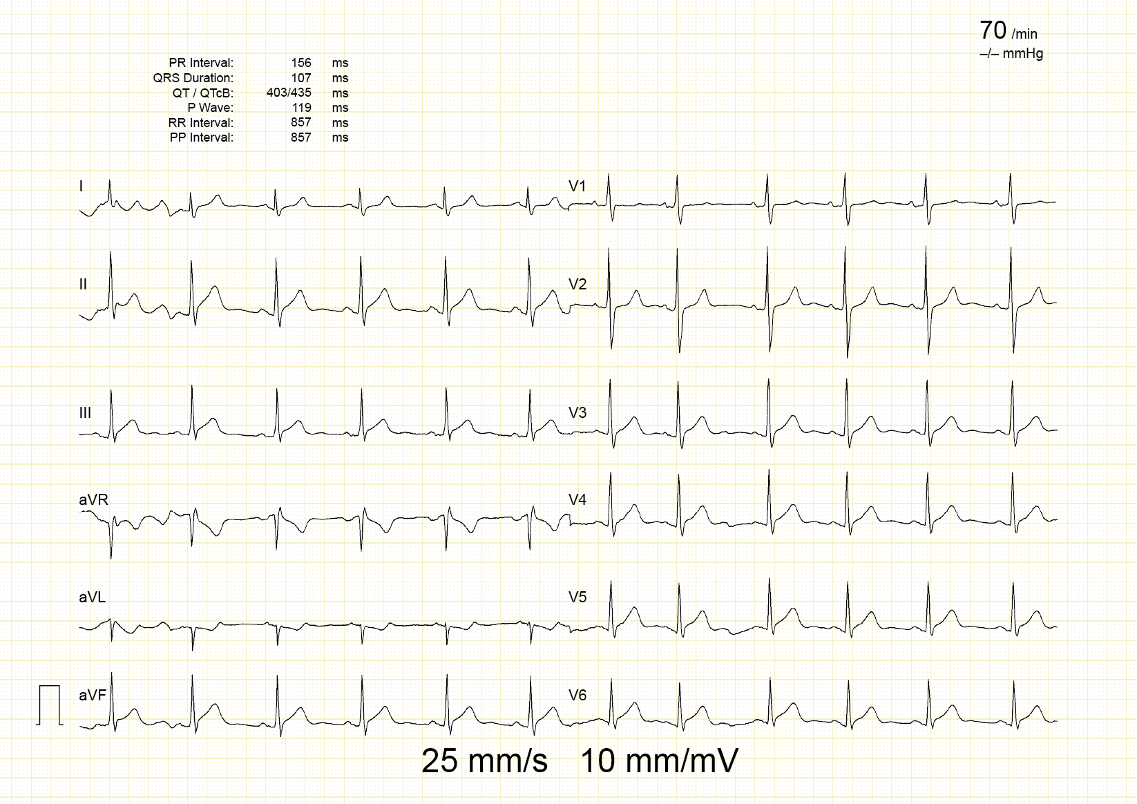 12-lead ECG recorded at 25 mm/s and 10 mm/mV throughout