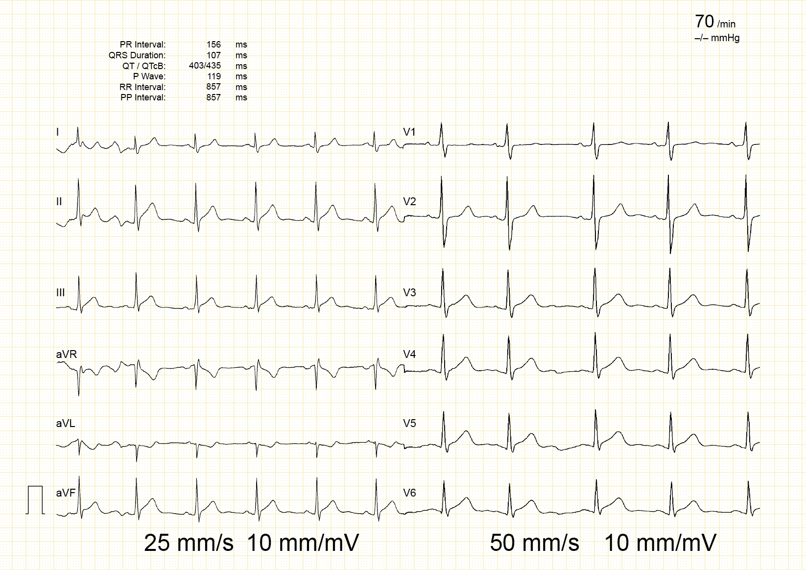 12-lead ECG mixing 25 mm/s and 50 mm/s across its leads