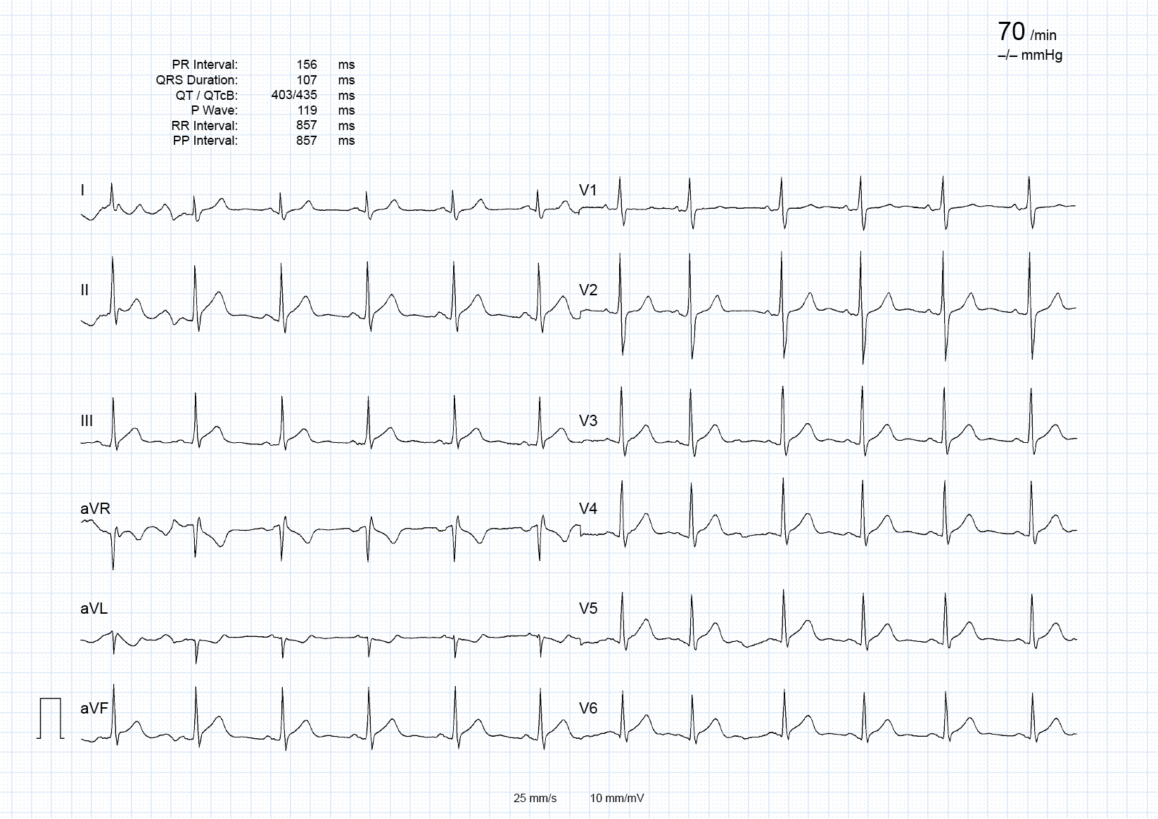 12-lead ECG with every lead captured in full