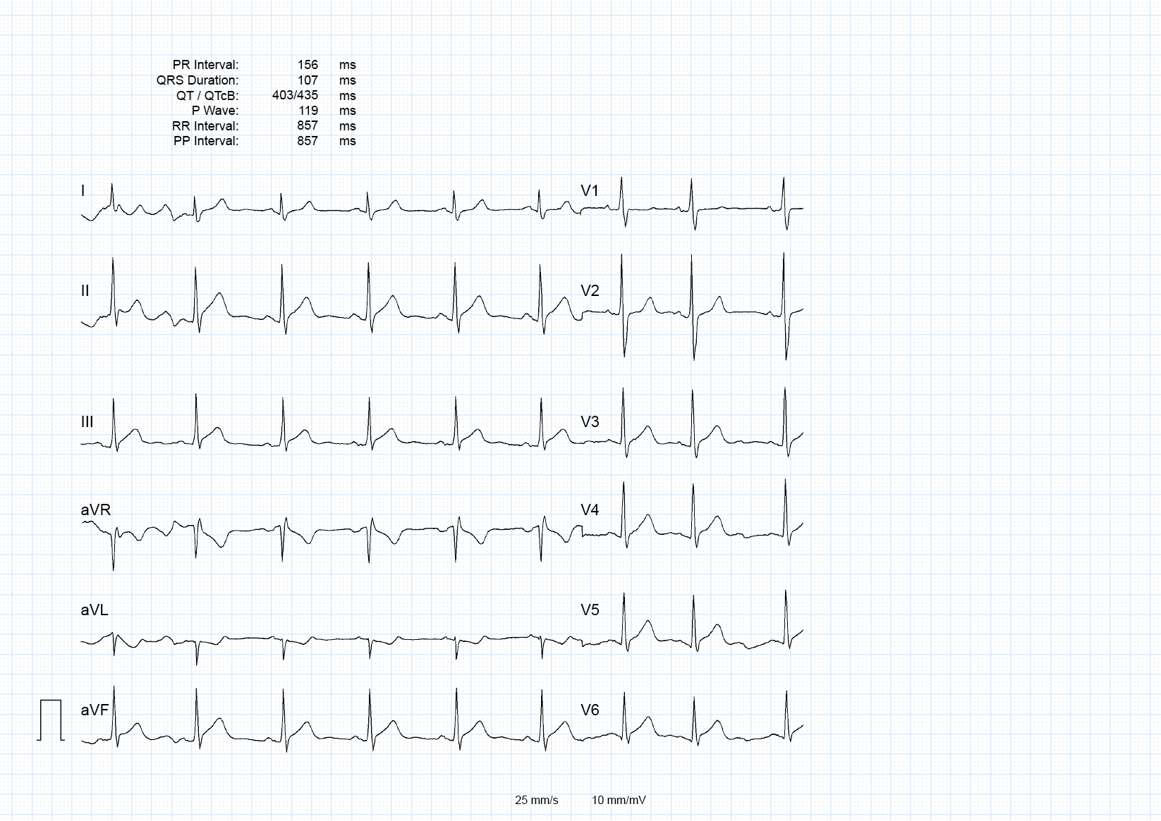 The same ECG with the chest leads cut short