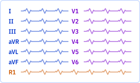 ECG layout: 1 page, 6x2 leads + Rhythm lead