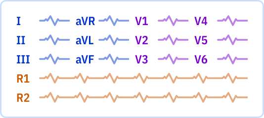 ECG layout: 1 page, 3x4 leads + 2 Rhythm leads