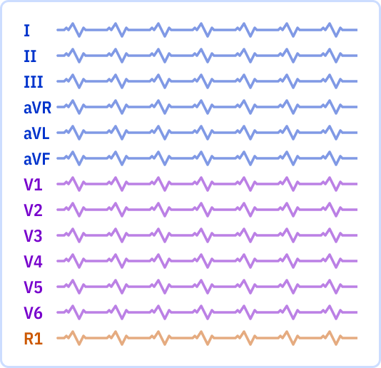 ECG layout: 1 page, 12x1 leads + Rhythm lead