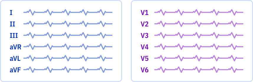 ECG layout: 2 pages, 6x1 leads